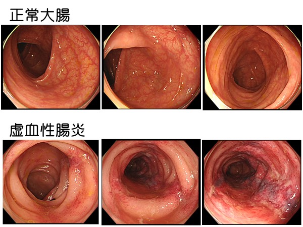 宇都宮市のひらしま胃腸・内科｜胃カメラ検査（胃内視鏡検査） 大腸内視鏡